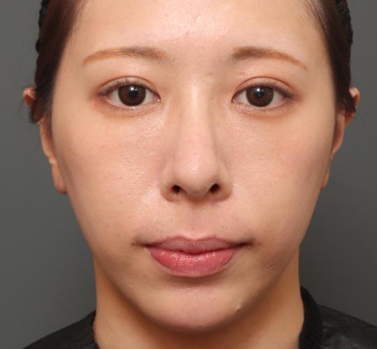 20代女性の人中短縮(リップリフト) Before 症例写真