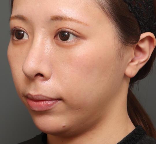 20代女性の人中短縮(リップリフト) Before 症例写真