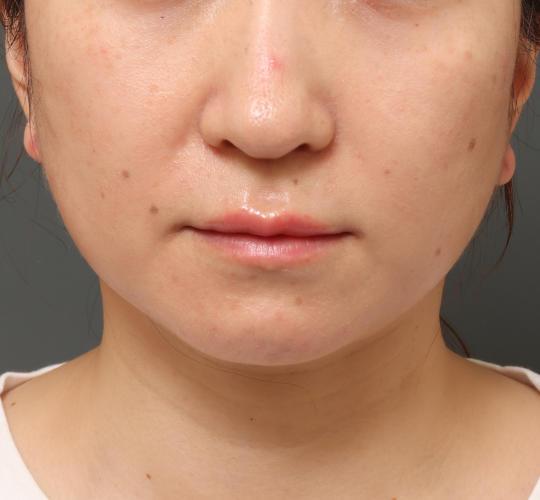 30代女性の人中短縮ボトックス After 症例写真