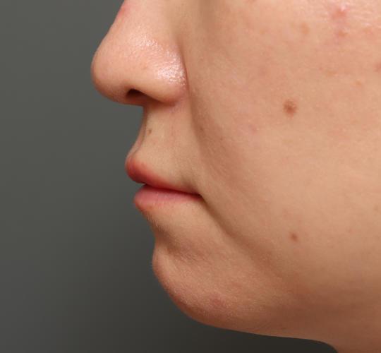 30代女性の人中短縮ボトックス After 症例写真