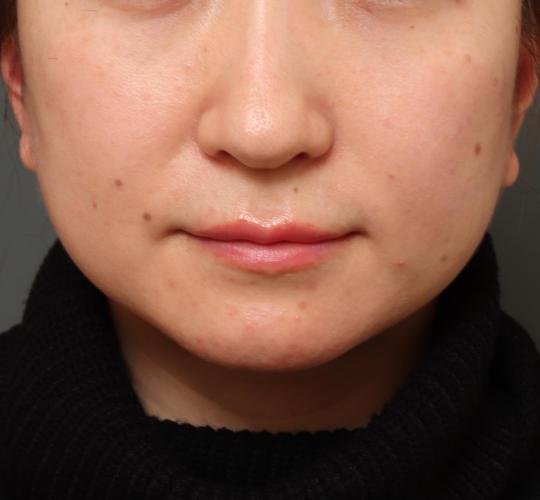 30代女性の人中短縮ボトックス Before 症例写真