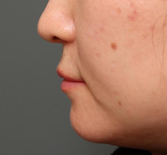 30代女性の人中短縮ボトックス Before 症例写真