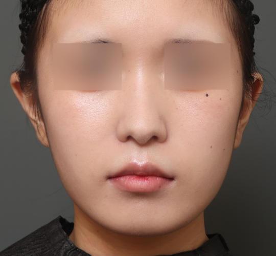 10代女性の鼻の整形 After 症例写真