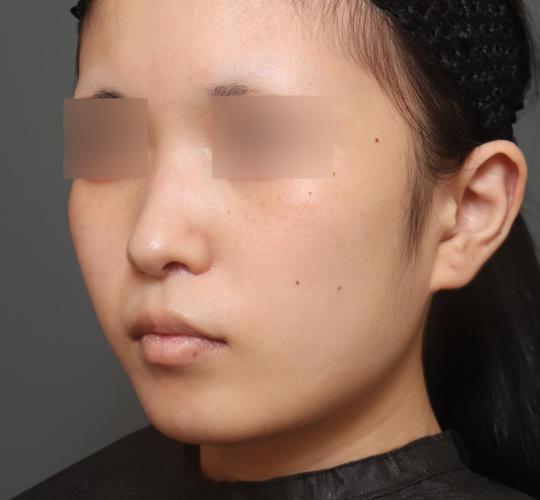 10代女性の人中短縮（リップリフト） After 症例写真