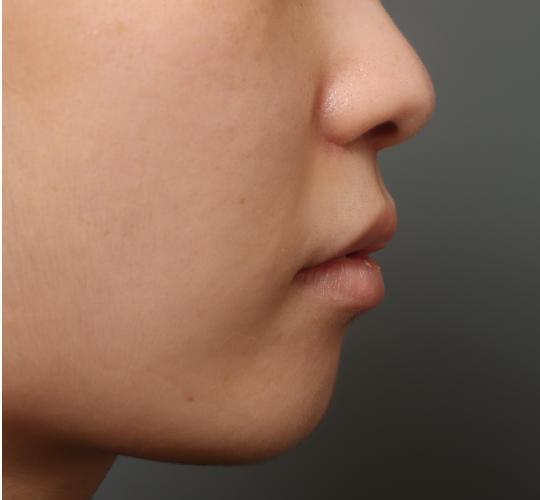 10代女性の人中短縮（リップリフト） After 症例写真