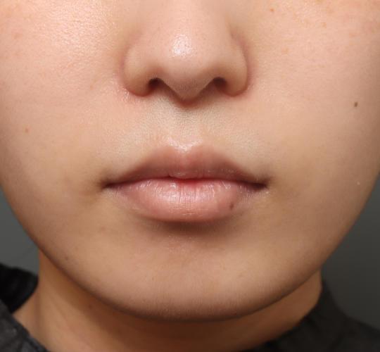 10代女性の人中短縮（リップリフト） After 症例写真