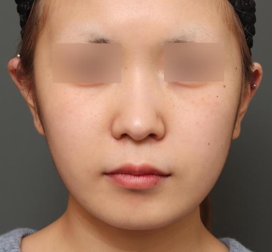 10代女性の鼻の整形 Before 症例写真