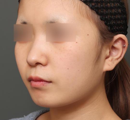 10代女性の人中短縮（リップリフト） Before 症例写真