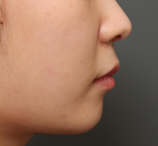 10代女性の人中短縮（リップリフト） Before 症例写真