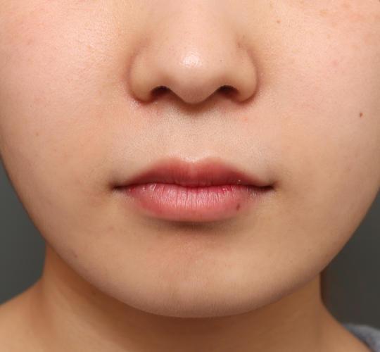 10代女性の人中短縮（リップリフト） Before 症例写真