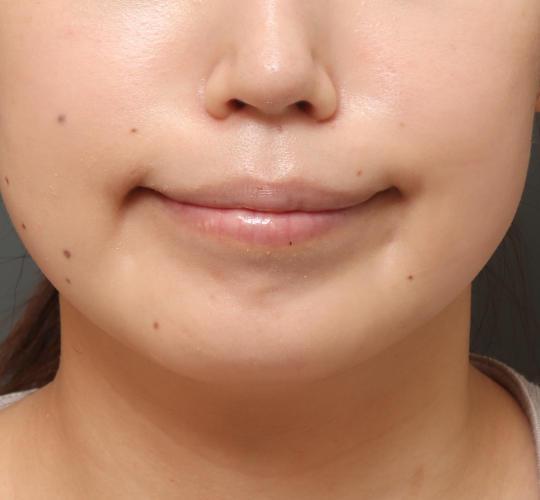 30代女性の唇・口元の整形 After 症例写真