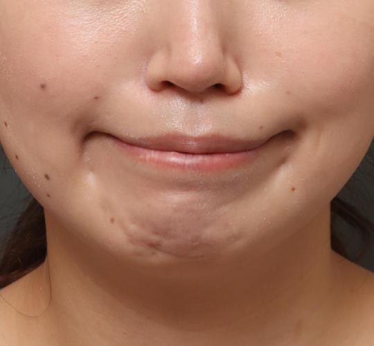 30代女性の唇・口元の整形 Before 症例写真