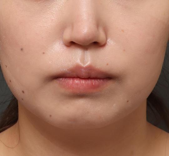 30代女性のボトックス（口角） Before 症例写真