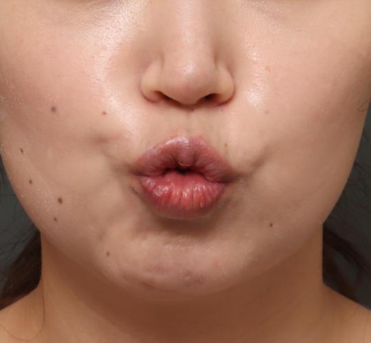 30代女性のボトックス（口角） Before 症例写真