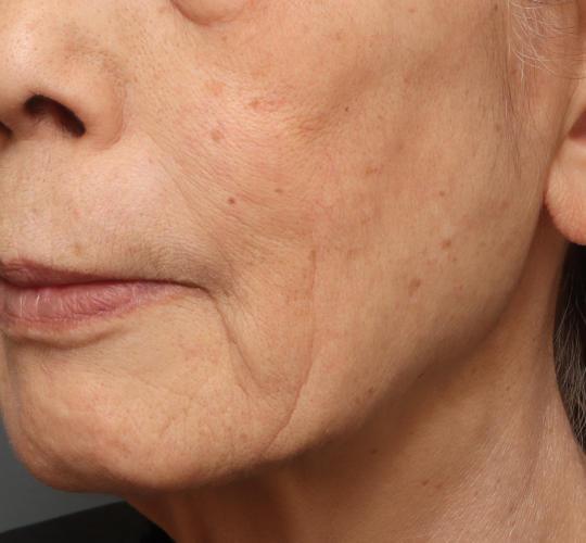 70代女性のジュビダームビスタ ボライト（スキンバイブ） After 症例写真