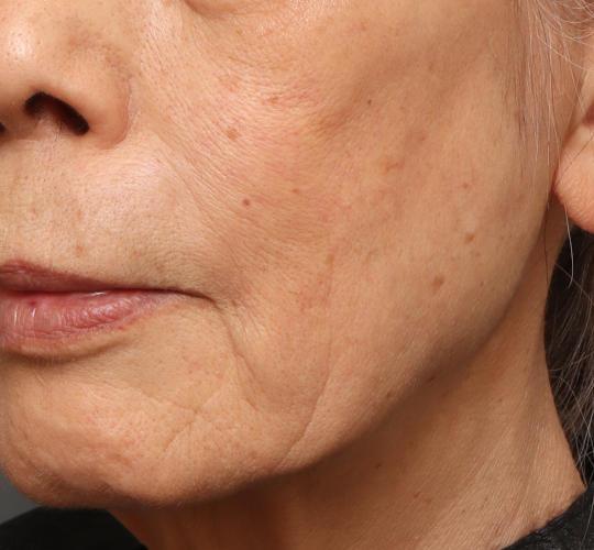 70代女性のジュビダームビスタ ボライト（スキンバイブ） Before 症例写真