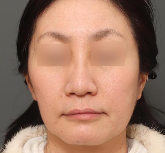 50代女性の毛穴・黒ずみ After 症例写真