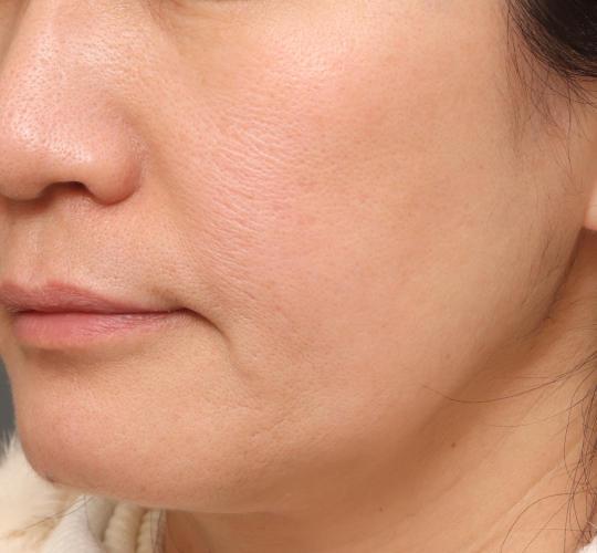 50代女性のヴァンパイアフェイシャル After 症例写真