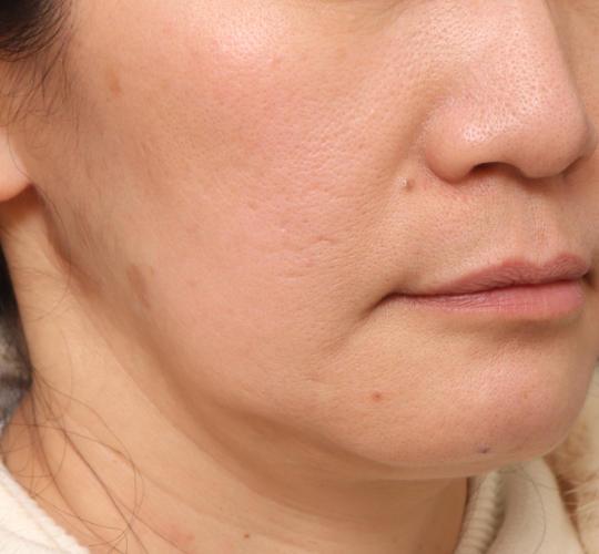 50代女性のヴァンパイアフェイシャル After 症例写真