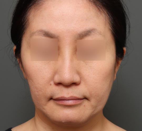 50代女性の毛穴・黒ずみ Before 症例写真