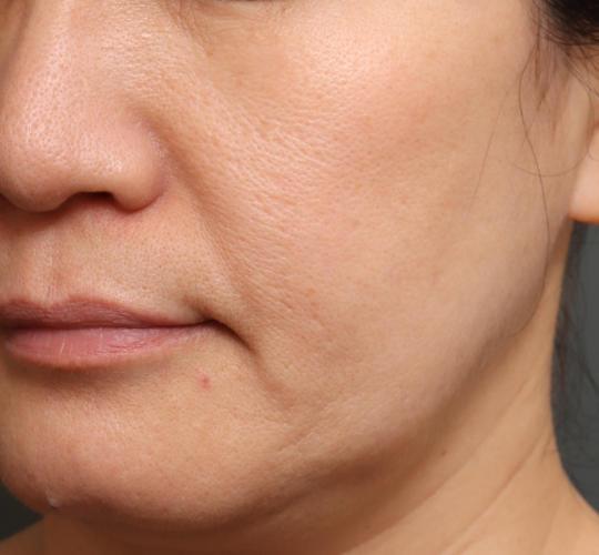 50代女性のヴァンパイアフェイシャル Before 症例写真