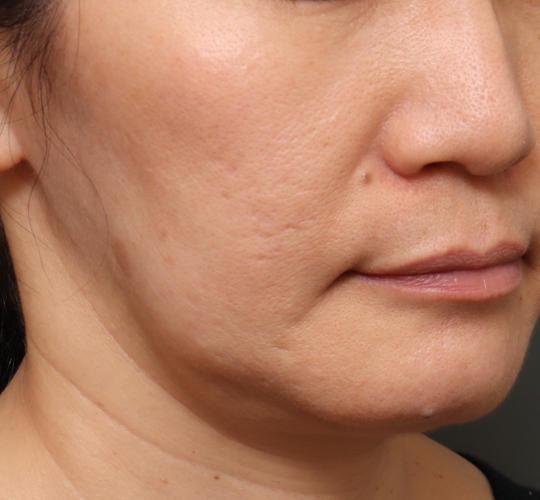 50代女性のヴァンパイアフェイシャル Before 症例写真