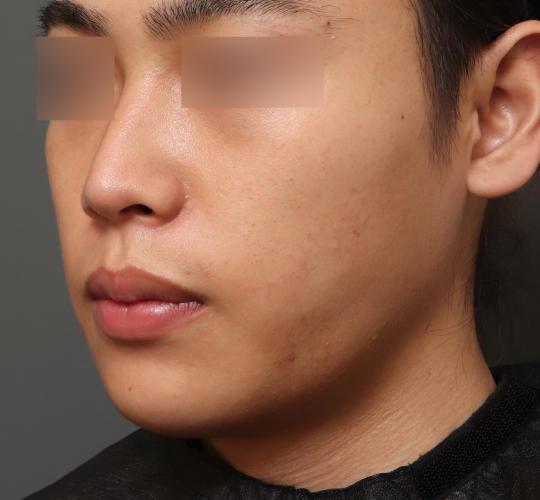 20代男性の脂肪吸引・痩身 After 症例写真