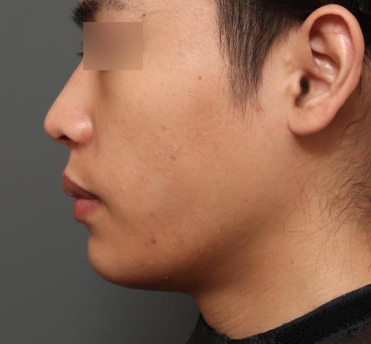 20代男性のフェイスタイト After 症例写真