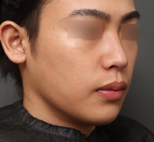 20代男性のフェイスタイト After 症例写真