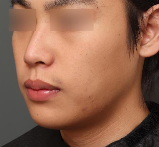 20代男性の脂肪吸引・痩身 Before 症例写真