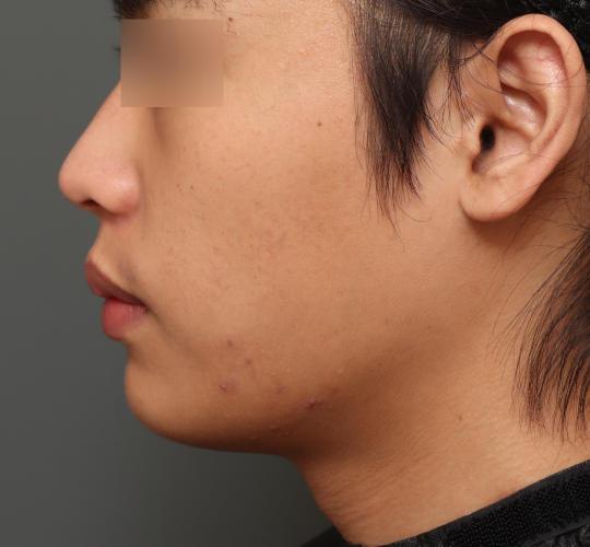 20代男性のフェイスタイト Before 症例写真