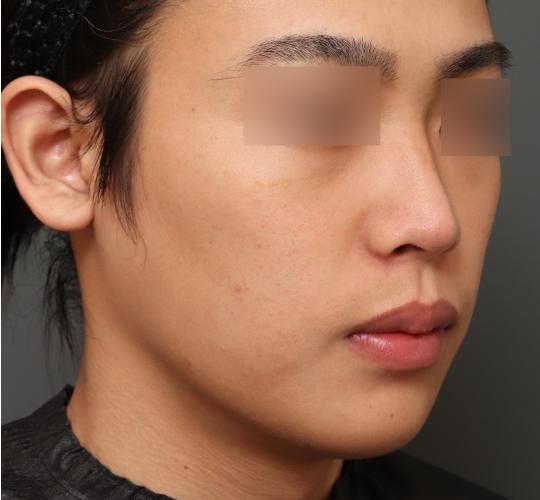 20代男性のフェイスタイト Before 症例写真