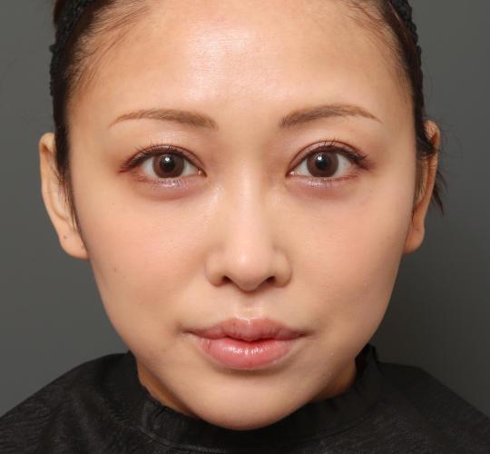 30代女性の人中短縮（リップリフト） After 症例写真