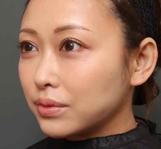 30代女性の人中短縮（リップリフト） After 症例写真