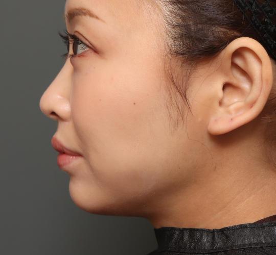 30代女性の人中短縮（リップリフト） After 症例写真