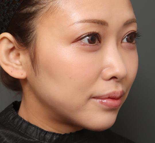 30代女性の人中短縮（リップリフト） After 症例写真