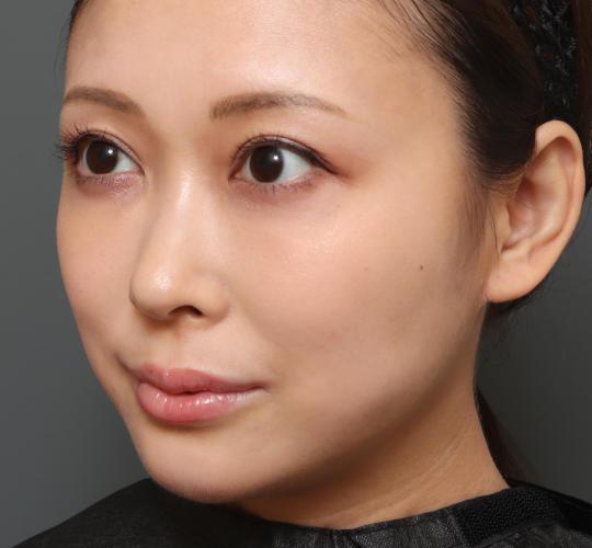 30代女性の人中短縮（リップリフト） Before 症例写真
