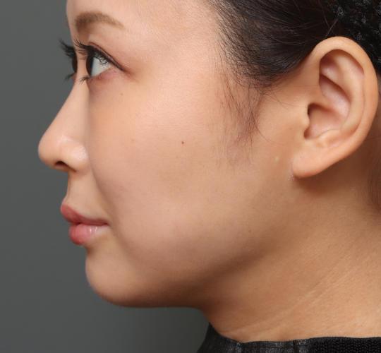 30代女性の人中短縮（リップリフト） Before 症例写真