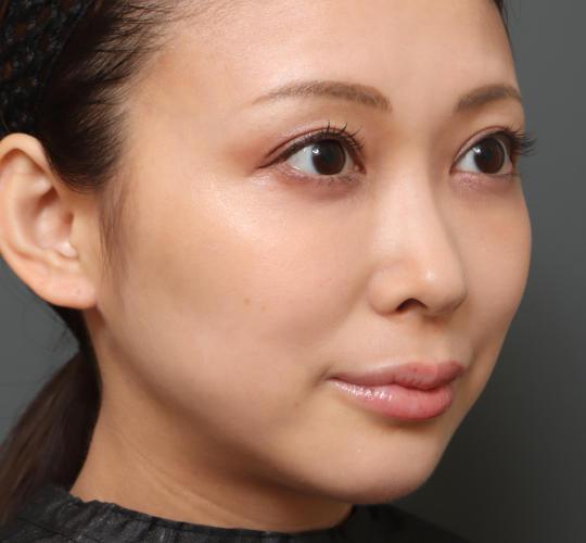 30代女性の人中短縮（リップリフト） Before 症例写真