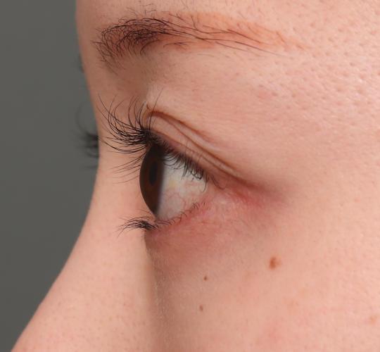 20代女性のタレ目・でか目形成 After 症例写真