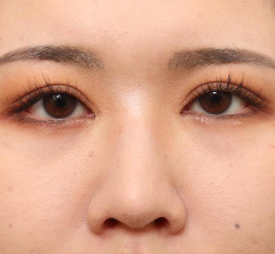 20代女性の目つき矯正 After 症例写真