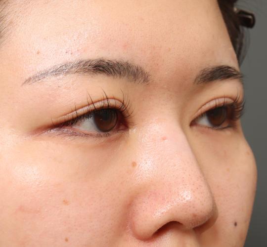 20代女性の目つき矯正 After 症例写真