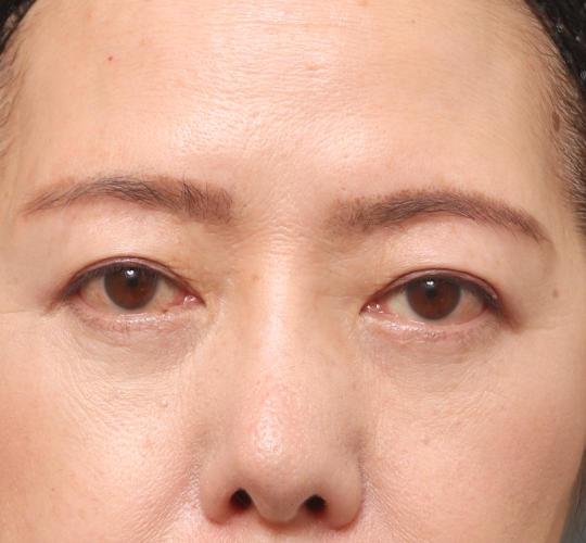 60代女性の眉下切開法 After 症例写真