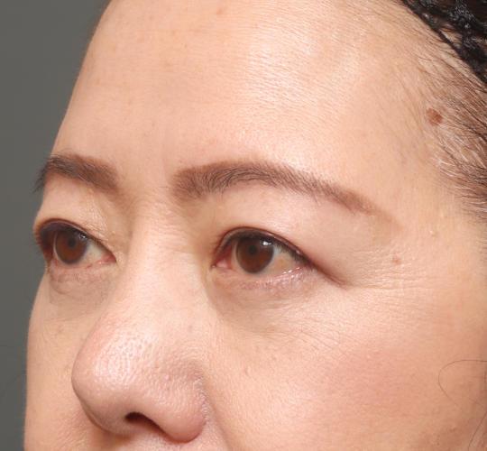 60代女性の眉下切開法 After 症例写真