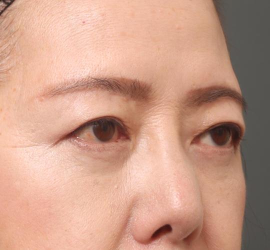 60代女性の眉下切開法 After 症例写真