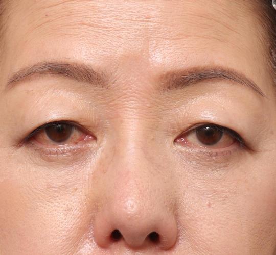 60代女性の眉下切開法 Before 症例写真