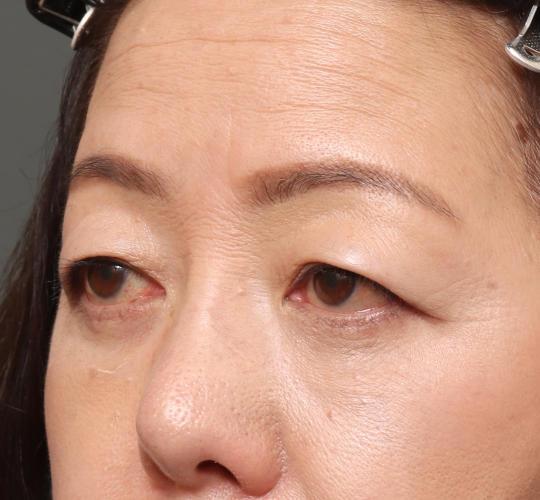 60代女性の眉下切開法 Before 症例写真
