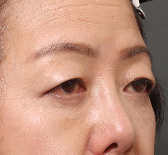 60代女性の眉下切開法 Before 症例写真