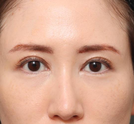 20代女性の眉下切開法 After 症例写真