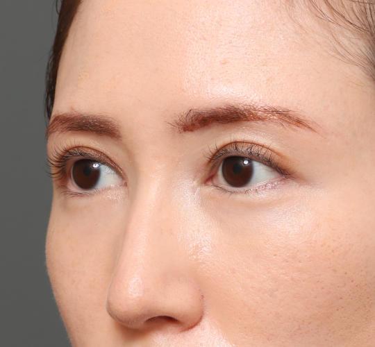20代女性の眉下切開法 After 症例写真